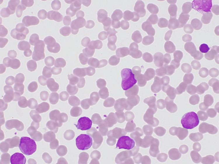 Knochenmark im Hellfeld, Auer-Stab. Aufgenommen mit ZEISS Axioscope 5