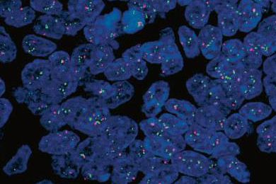 HER2-Zentromer, Fluoreszenzkontrast Brockhoff working group, Institute of Pathology, University of Regensburg, Germany