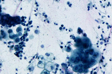lung_lcm_390x260